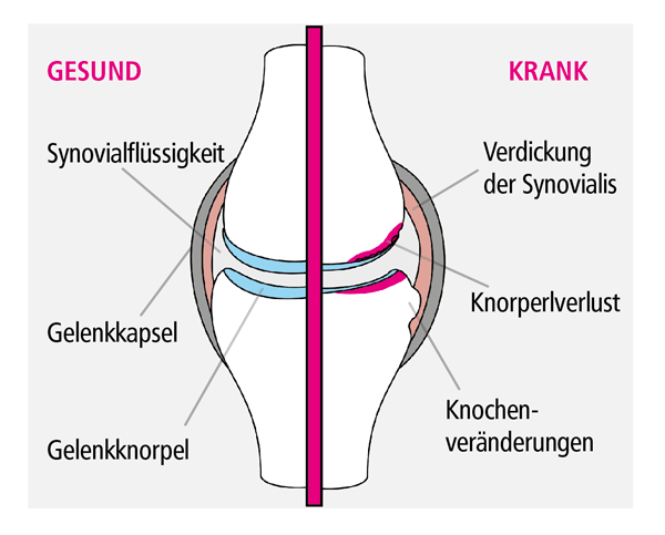 Gelenkgrafik